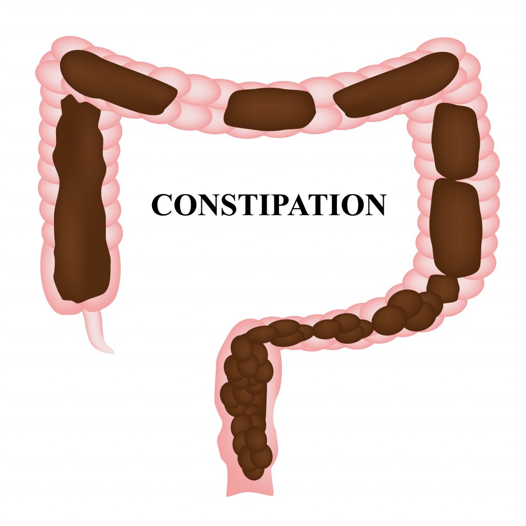 constipated colon illustration