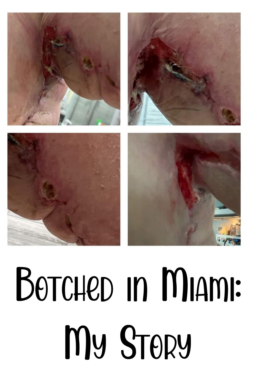 “Botched in Miami”: Ashley P's Story