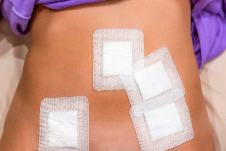 How to Care for Your Gastric Sleeve Incisions Tuck and Sleeve
